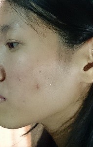 способы лечения себореи на лице