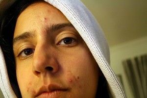Симптомы себореи на лице